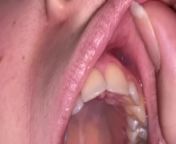 Dental examination. Teeth tour from uvula teeth